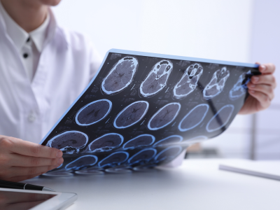  multiple sclerosis