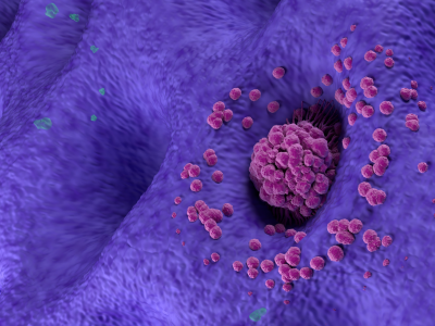 NCCN Guidelines
