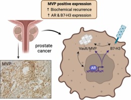 Correlation of expression of Major Vault Protein with androgen receptor and immune checkpoint protein B7-H3, and with poor prognosis in prostate cancer