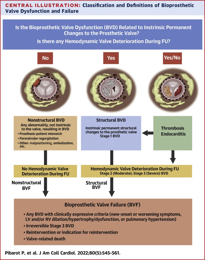 Standardized Definitions for Bioprosthetic Valve Dysfunction Following Aortic or Mitral Valve Replacement: JACC State-of-the-Art Review