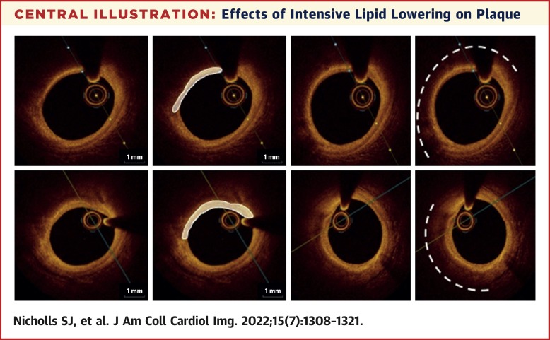 Effect of Evolocumab on Coronary Plaque Phenotype and Burden in Statin-Treated Patients Following Myocardial Infarction