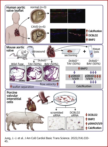 Differential BMP Signaling Mediates the Interplay Between Genetics and Leaflet Numbers in Aortic Valve Calcification