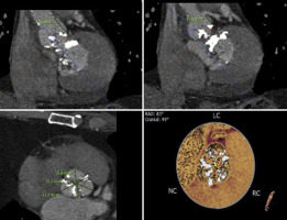 Aortic Valve Leaflet Rupture Causing Delayed Left Main Coronary Ostial Obstruction During Valvuloplasty Preceding TAVR
