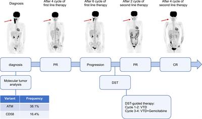 Case report: Successful management of a refractory double-expressor diffuse large B-cell lymphoma patient under the guidance of in vitro high-throughput drug sensitivity test