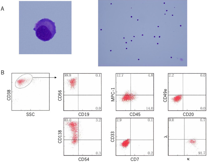 Multiple Myeloma with Central Nervous System Relapse Early after Autologous Stem Cell Transplantation: A Case Report and Literature Review.