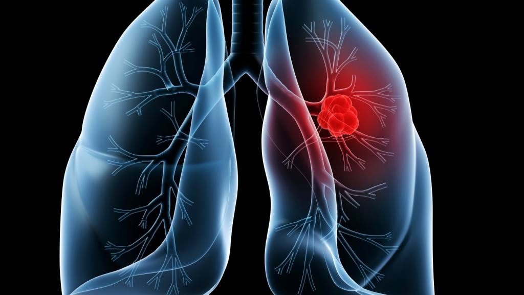 Mayo Clinic study suggests patients with lung cancer be screened for MET oncogene