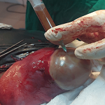 Pyomyoma in a primigravida at term: a case report