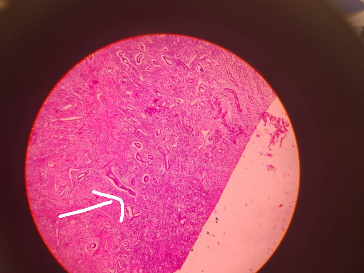 Adenomyosis in a postmenopausal woman: A rare entity