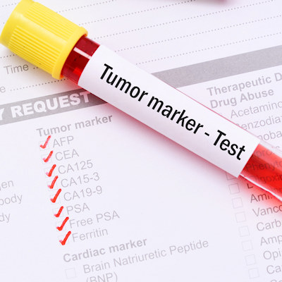 Oncologists urge faster biomarker results for lung cancer patients