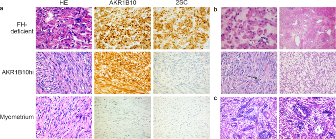 A novel uterine leiomyoma subtype exhibits NRF2 activation and mutations in genes associated with neddylation of the Cullin 3-RING E3 ligase - Oncogenesis