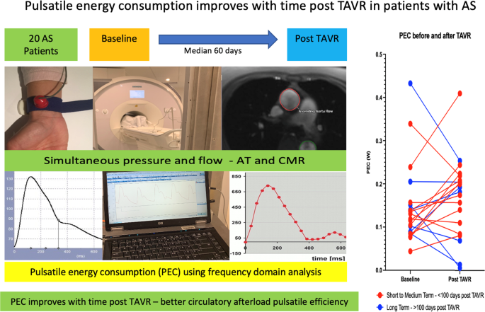 Pulsatile energy consumption as a surrogate marker for vascular afterload improves with time post transcatheter aortic valve replacement in patients with aortic stenosis - Hypertension Research