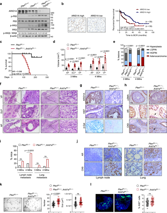 ARID1A loss induces polymorphonuclear myeloid-derived suppressor cell chemotaxis and promotes prostate cancer progression - Nature Communications