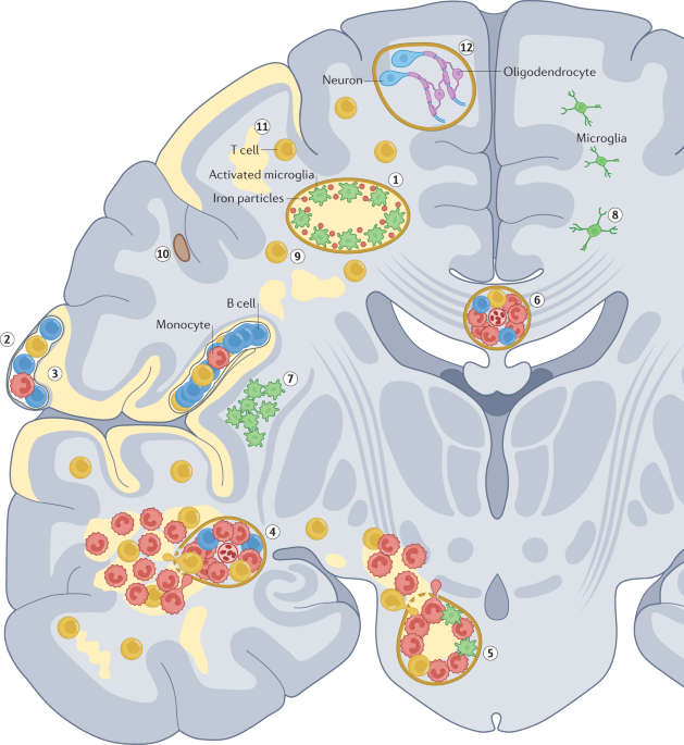 Mechanism-based criteria to improve therapeutic outcomes in progressive multiple sclerosis - Nature Reviews Neurology