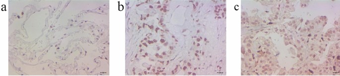 High expression of hypoxia inducible factor 1α related with acquired resistant to EGFR tyrosine kinase inhibitors in NSCLC