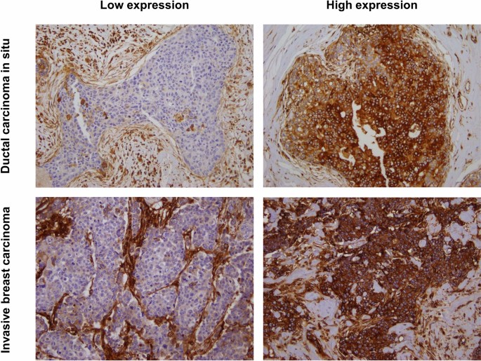 Expression of HLA class I is associated with immune cell infiltration and patient outcome in breast cancer - Scientific Reports