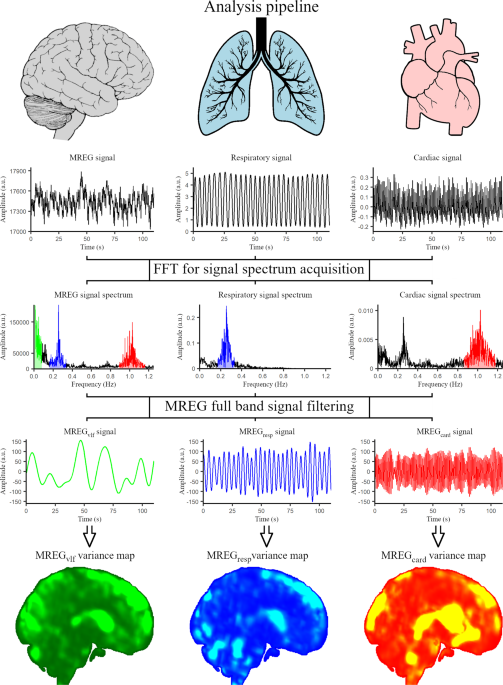 Increased very low frequency pulsations and decreased cardiorespiratory pulsations suggest altered brain clearance in narcolepsy - Communications Medicine