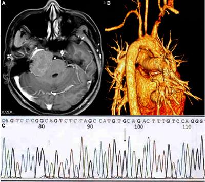Treatment of Familial Hypercholesterolemia with Intracranial Xanthoma: Case Report