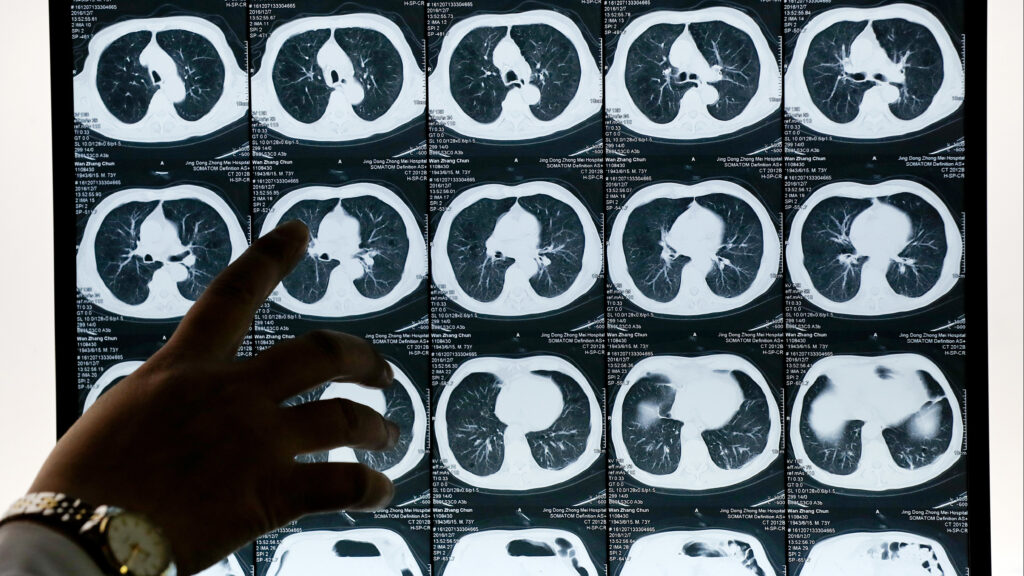 With new data on its KRAS-blocking lung cancer drug, Mirati expects to take on a rival Amgen treatment