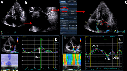 Early reduction of left atrial function predicts adverse clinical outcomes in patients with severe aortic stenosis undergoing transcatheter aortic valve replacement