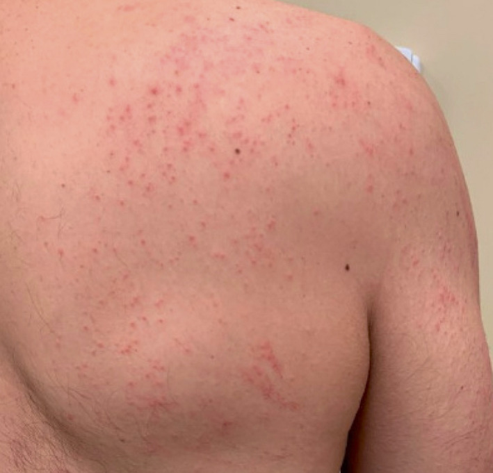 Generalized eczematous reactions to the Pfizer-BioNTech COVID-19 vaccine.