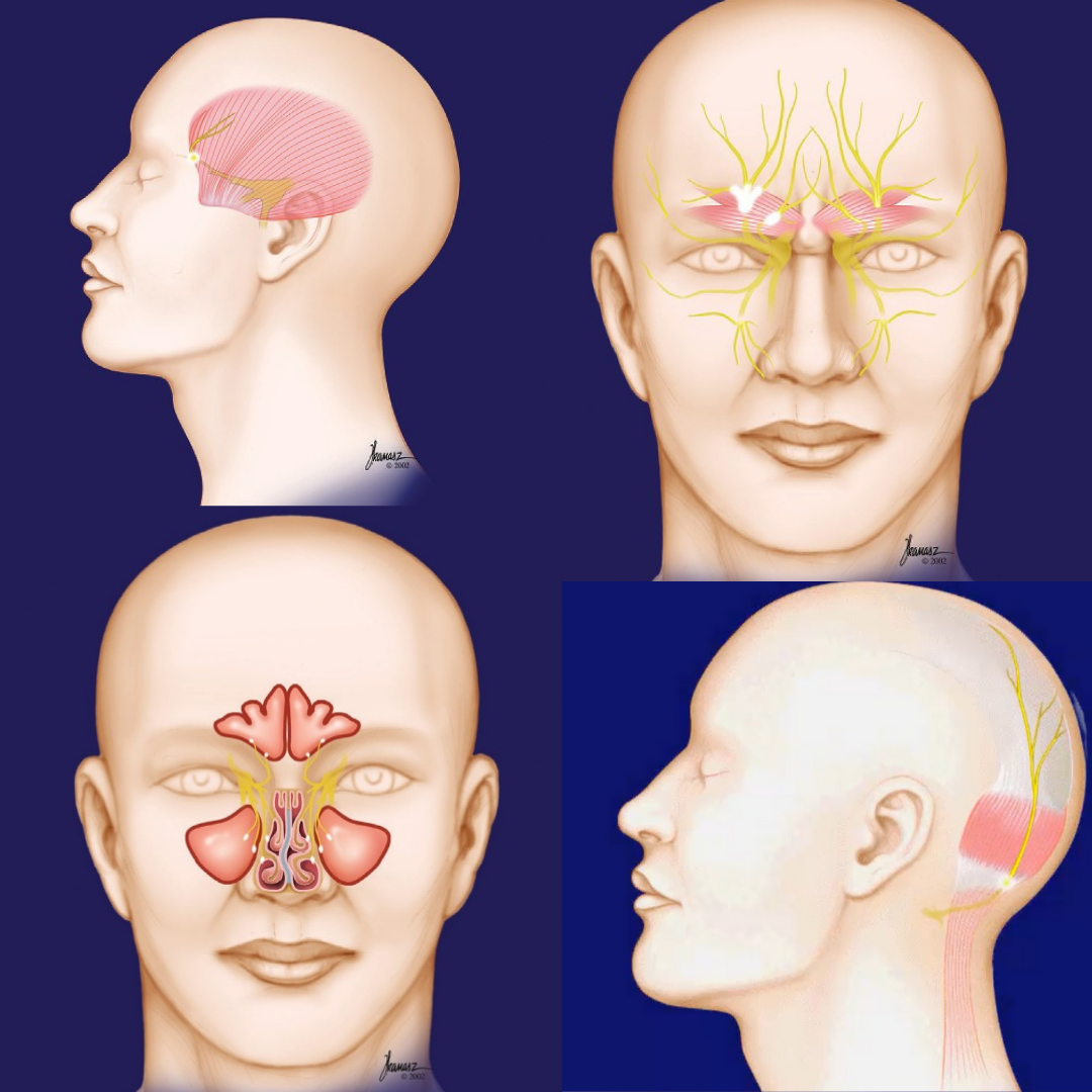 THE SURGICAL TREATMENT OF MIGRAINE HEADACHES (MIGRAINE SURGERY). HOW DOES IT WORK, AND WHAT SHOULD YOU EXPECT? - Virtual Headache Specialist