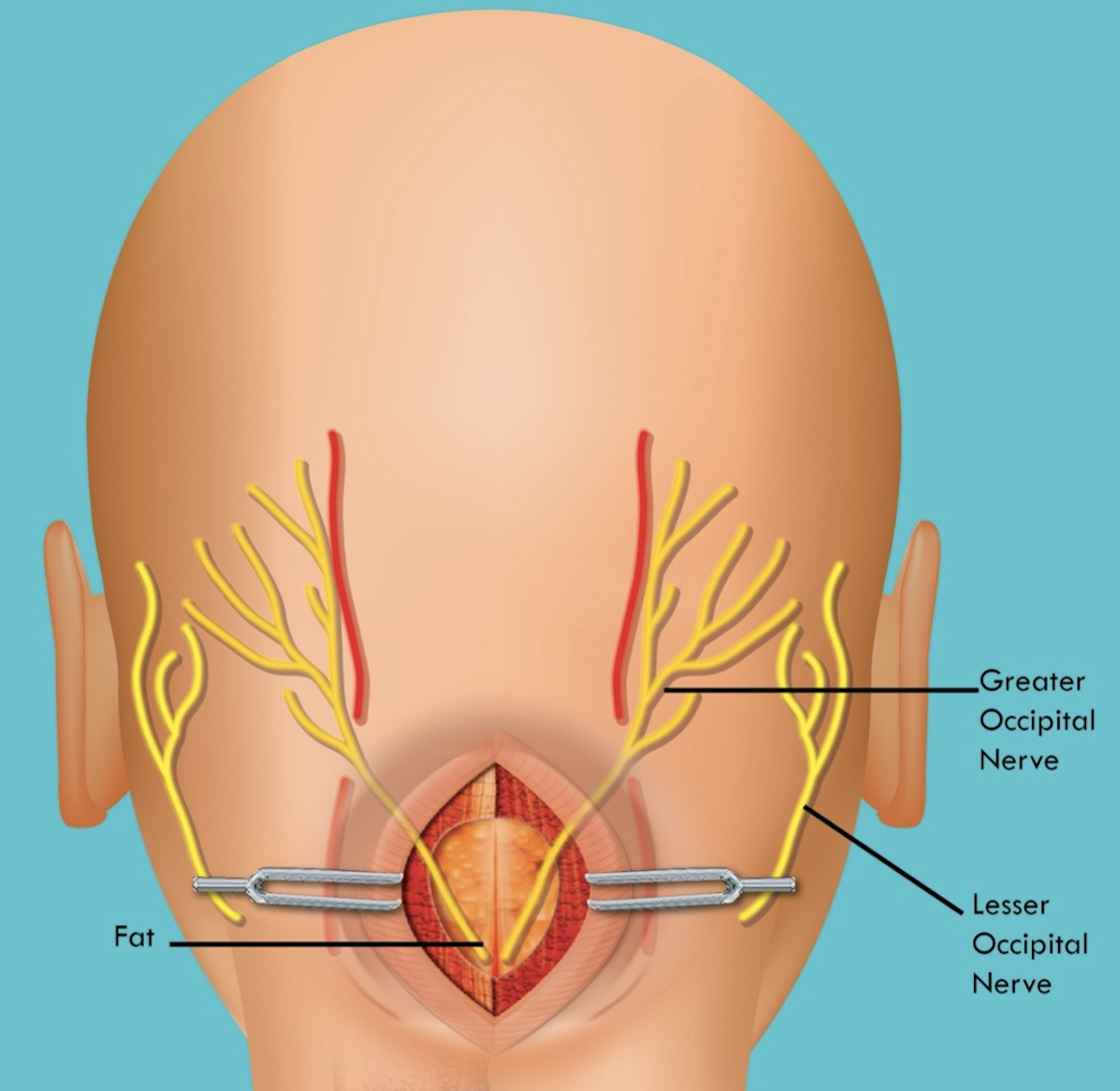 WHAT IS OCCIPITAL NERVE DECOMPRESSION FOR OCCIPITAL NEURALGIA, AND CAN IT HELP YOU? - Virtual Headache Specialist