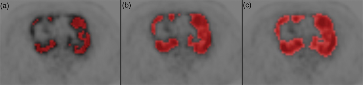 Prognostic parameters on baseline and interim... : Nuclear Medicine Communications