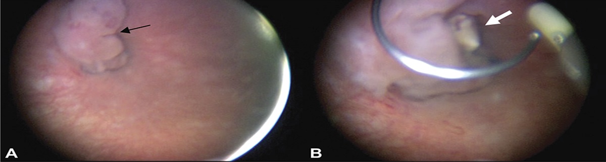 Complex Gynecologic Fistulas Presenting 10 Years After Uterine Artery Embolization