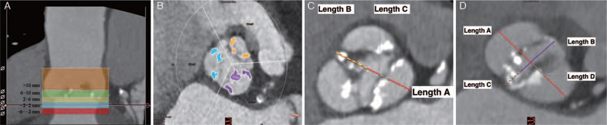 Anatomical morphology of the aortic valve in Chinese aortic stenosis patients and clinical results after downsize strategy of transcatheter aortic valve replacement