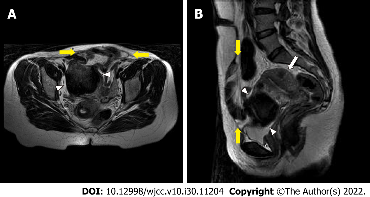 Ventral hernia after high-intensity focused ultrasound ablation for uterine fibroids treatment: A case report