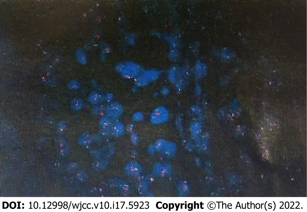 Loss of human epidermal receptor-2 in human epidermal receptor-2+ breast cancer after neoadjuvant treatment: A case report