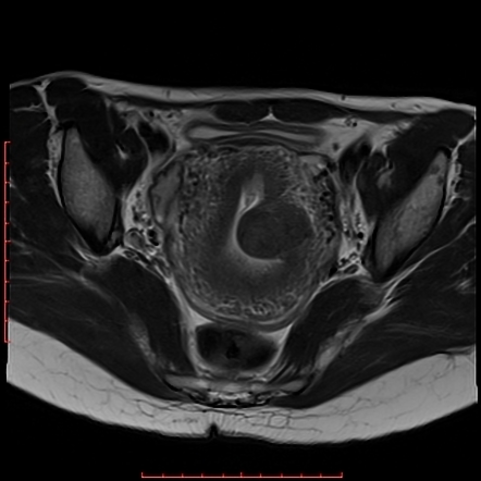 Submucosal uterine fibroid | Radiology Case | Radiopaedia.org