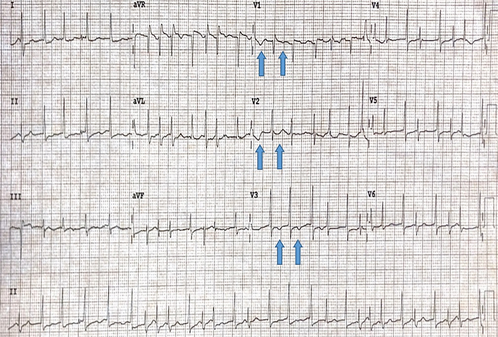 Atrial Fibrillation as a Possible Adverse Reaction to Evolocumab