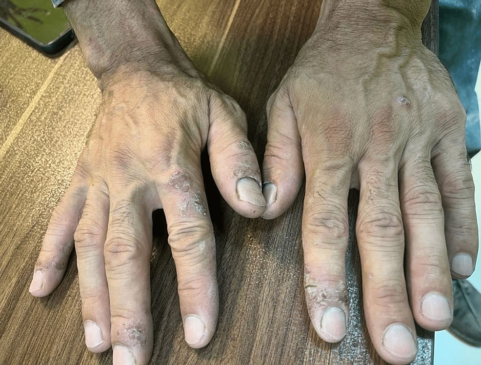 Allergic Contact Dermatitis in Refractory Brick Production Worker: A Case Report