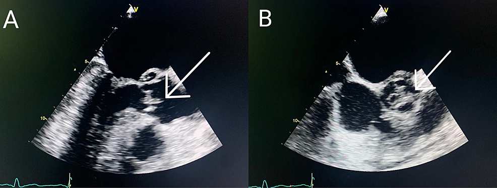 Confusion as an Unusual Presentation of Infective Endocarditis