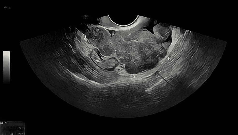 Iatrogenic Parasitic Leiomyomas: A Late and Uncommon Complication After Laparoscopic Morcellation