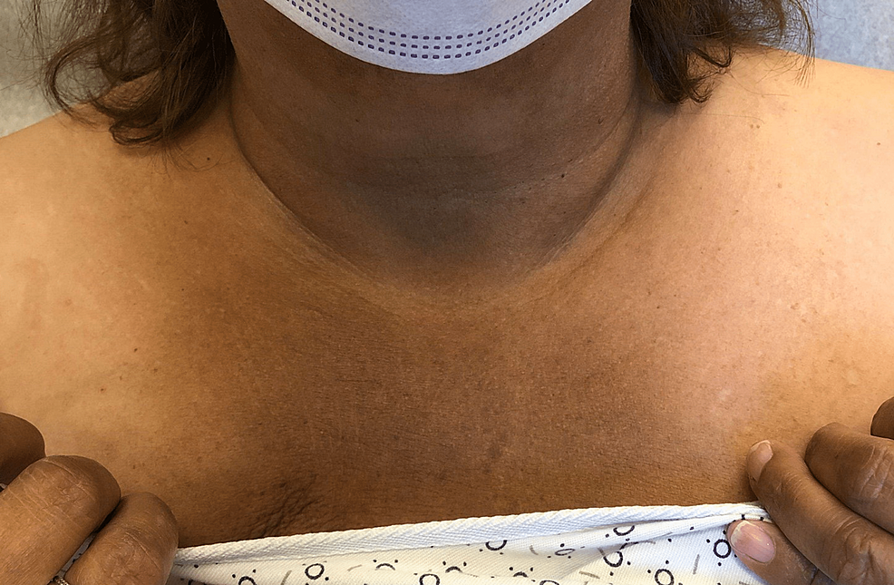 A Likely Case of Abemaciclib-Induced Hyperpigmentation in a Patient With Metastatic Breast Cancer