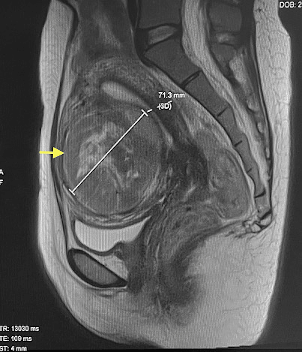 Successful Control of Heavy Menstrual Bleeding Using High-Intensity Focused Ultrasound Ablation of Fibroid Uterus in a Woman With Eisenmenger Syndrome