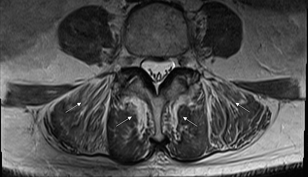 High-Intensity Statin With Severe Consequences: A Case of Non-autoimmune Rosuvastatin-Induced Myonecrosis