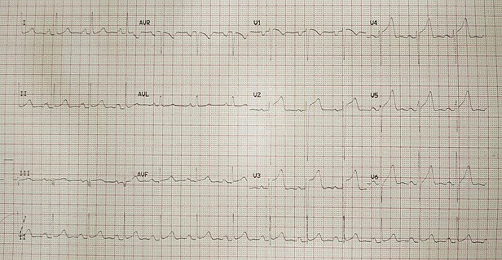 Incidental Diagnosis of Healed Aortic Abscess Cavity