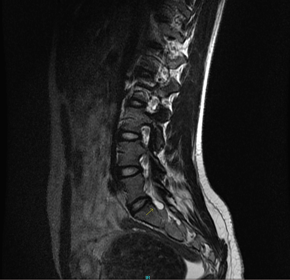 Sciatica in Early Pregnancy With Coexisting Uterine Leiomyoma and‌ ‌Tarlov‌ ‌Cyst:‌ ‌A‌ ‌Case Report