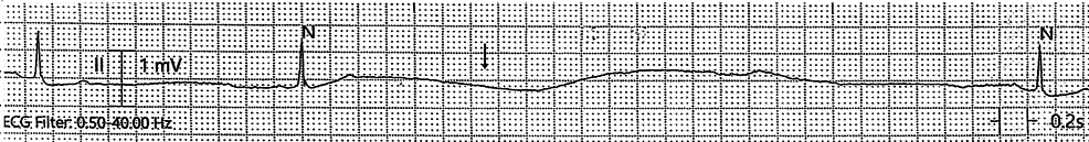Paxlovid-Induced Symptomatic Bradycardia and Syncope