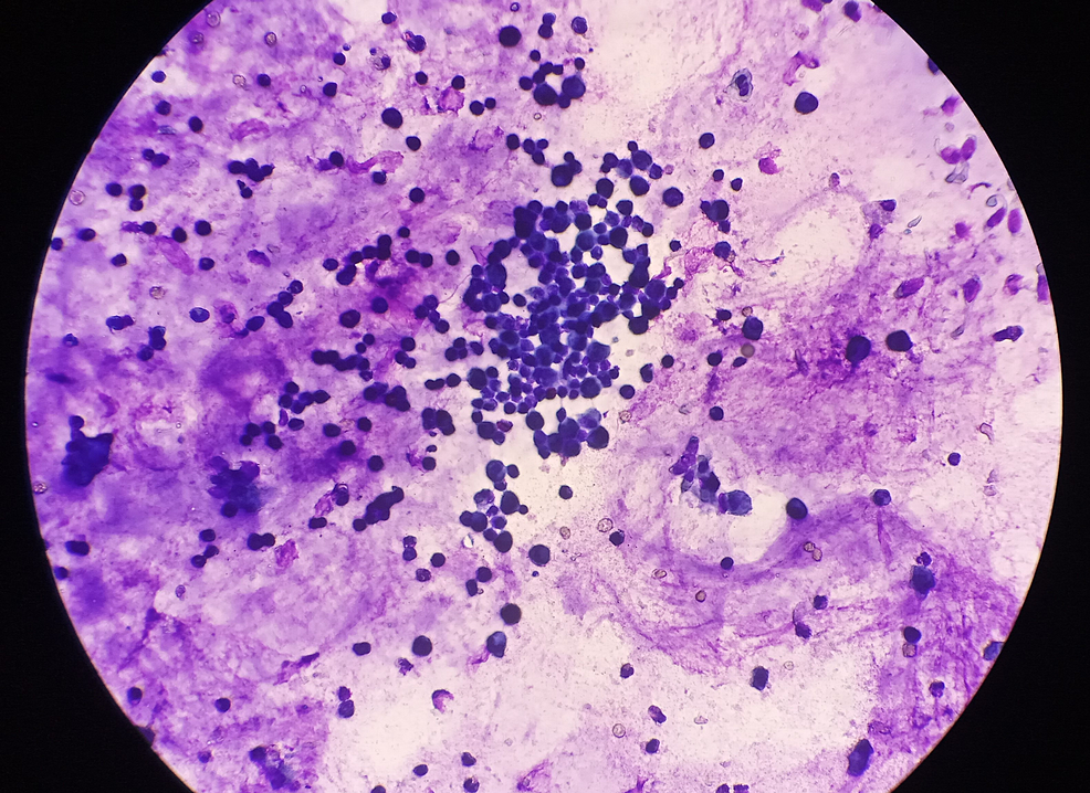 Achromobacter xylosoxidans Purulent Bronchitis in a Previously Healthy Child: An Unexpected Consequence of COVID-19 Infection