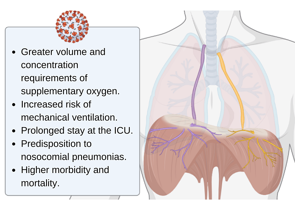 Acute Phrenic Neuropathy and Diaphragmatic Dysfunction as a Complication of COVID-19: A Report of Four Cases