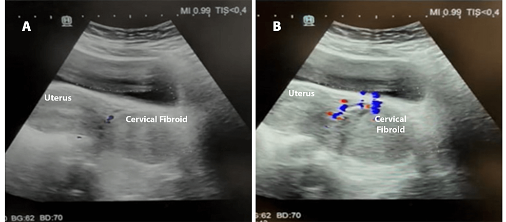Spontaneous Expulsion of a Huge Cervical Fibroid After Uterine Artery Embolization Done as a Lifesaving Procedure for Acute Severe Abnormal Uterine Bleeding