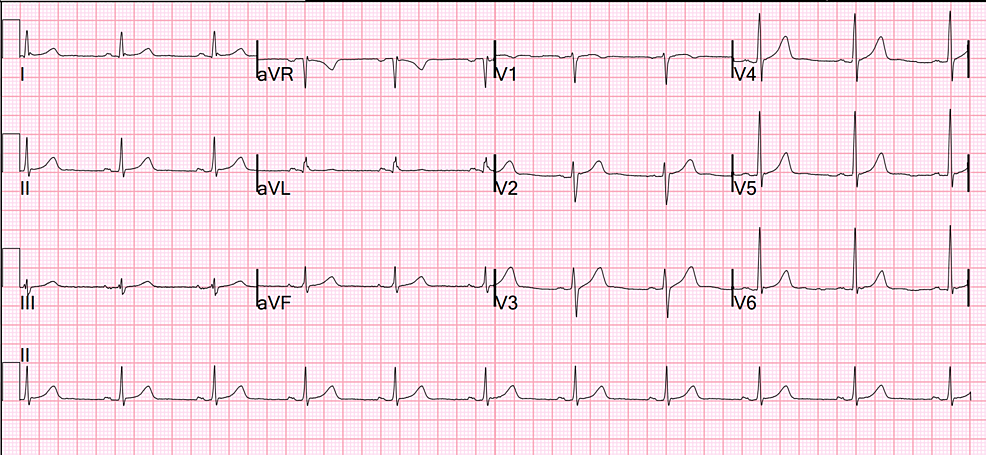 Seizures, Vitamin D Deficiency, and Severe Hypophosphatemia: The Unique Presentation of a SARS-CoV-2 Case