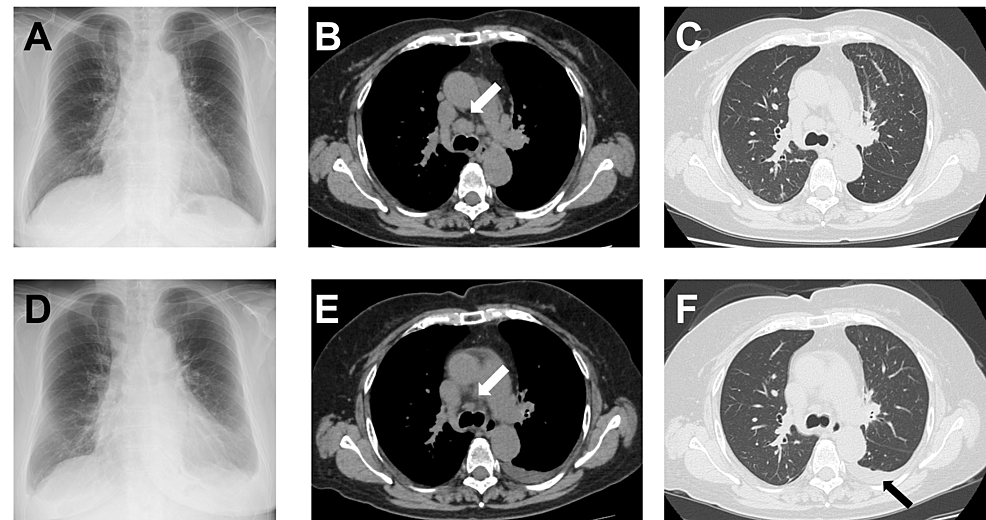 Entrectinib-Induced Heart Failure in a Patient With Metastatic Lung Adenocarcinoma: A Case Report