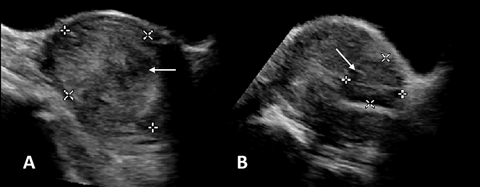 Uterine Myxoid Tumor: A Case Report on a Mysterious and Unexpected Diagnosis