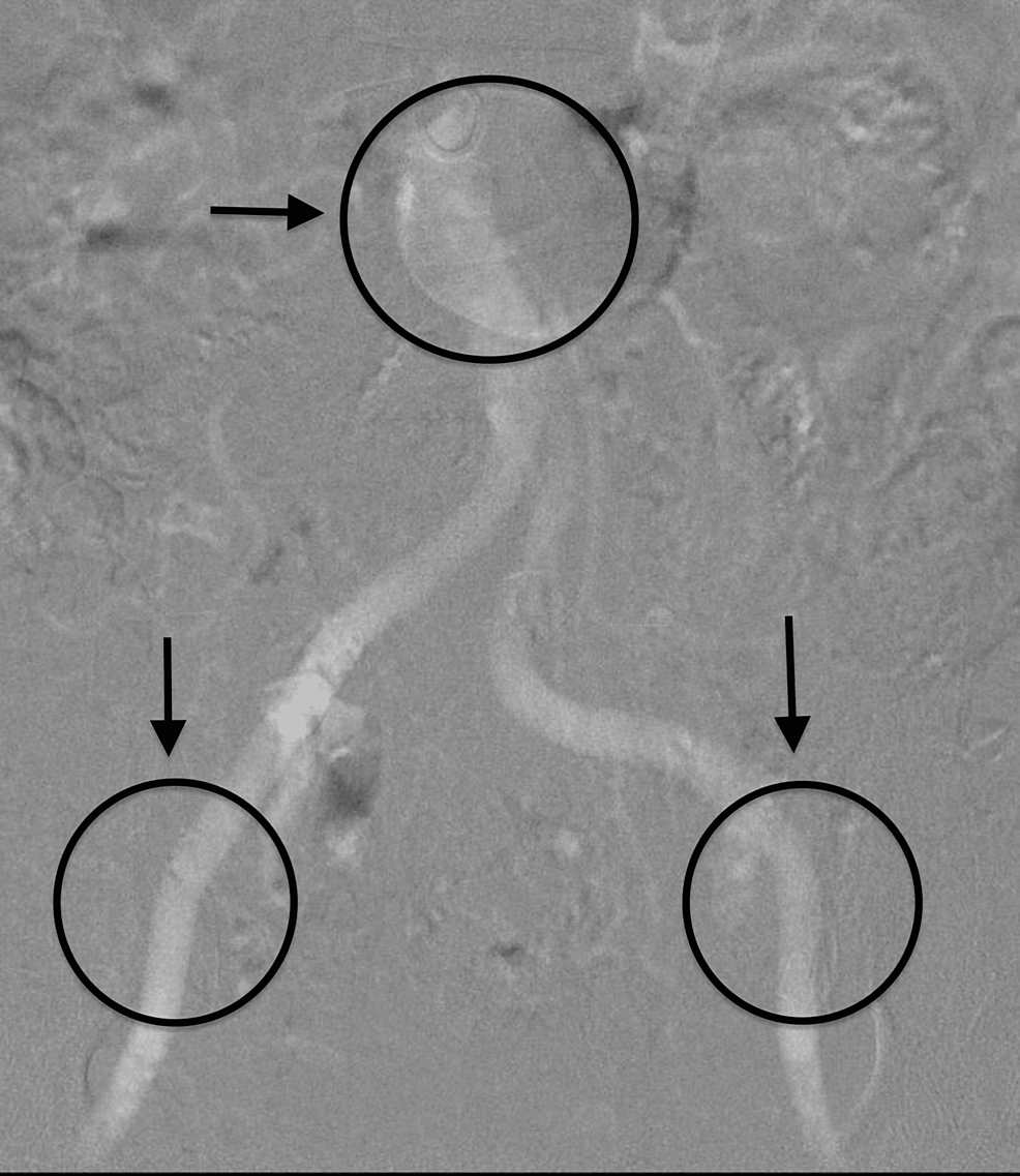 A Contrast Frugal Approach to Transcatheter Aortic Valve Replacement in Chronic Kidney Disease: A Pilot Study