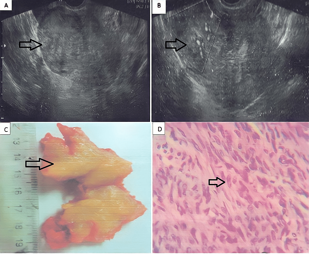 Highly Cellular Leiomyoma Mixed With a Focus of Adenomyosis